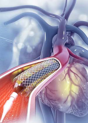 Doctor holding an anatomical heart model to explain a blocked artery treatment